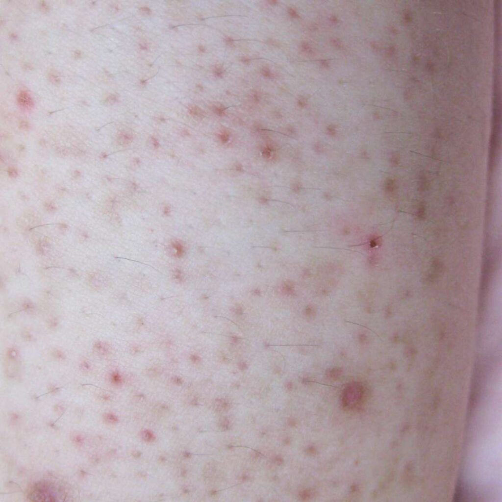 bild på hur keratosis pilaris kan se ut