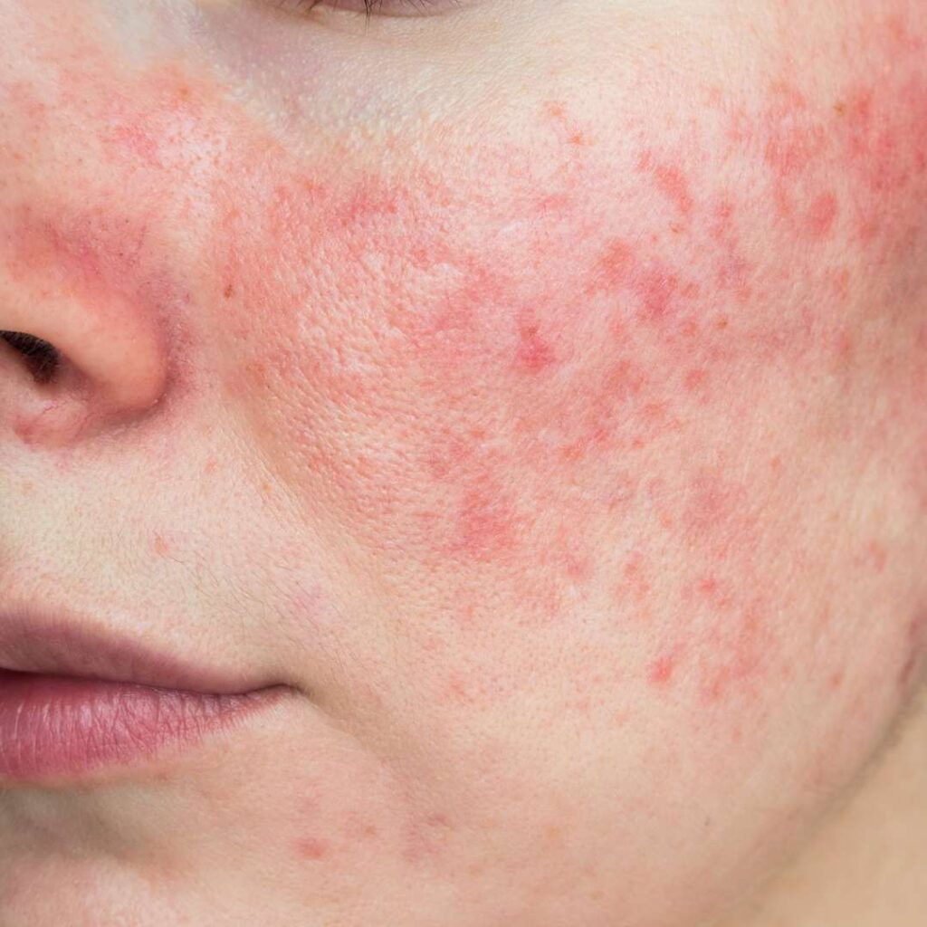 bild på mild rosacea
