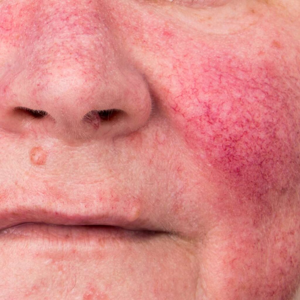 bild på rosacea på näsa och kinder