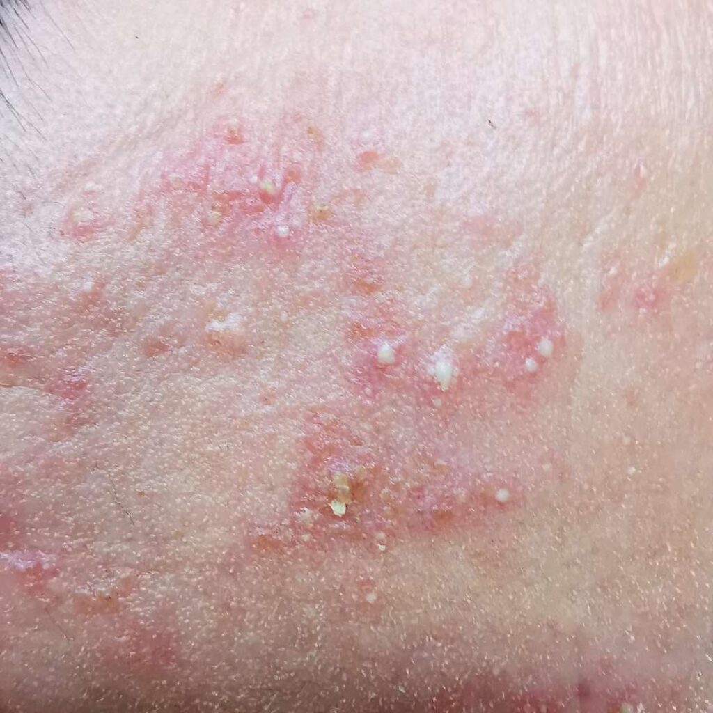 bild på utslag rosacea